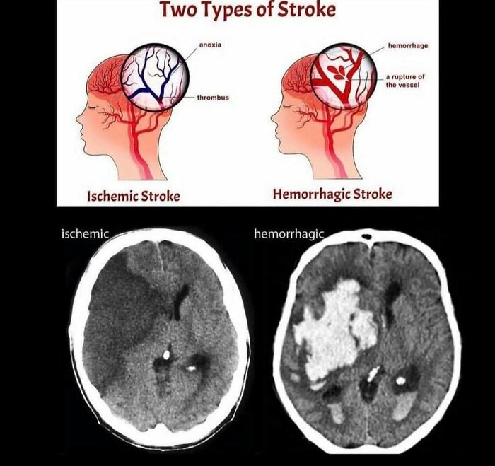 Diagram and brain scans showing two types of stroke, ischemic and hemorrhagic, highlighting medical differences in brain conditions.