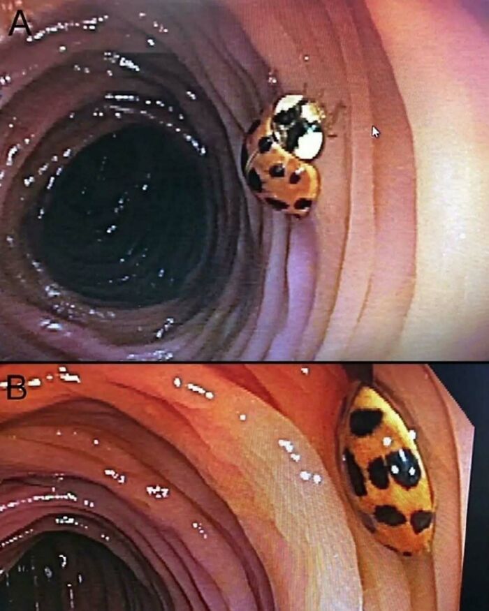 Imagen médica curiosa de un insecto dentro del colon humano, mostrando una vista interna inusual y ligeramente perturbadora.