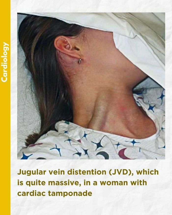 Close-up of massive jugular vein distention in a woman with cardiac tamponade shown in a medical setting.