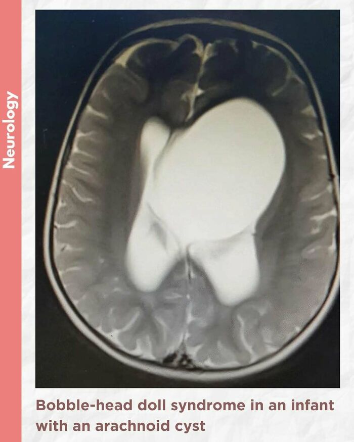 MRI scan showing an infant’s brain with an arachnoid cyst related to bobble-head doll syndrome medical pics