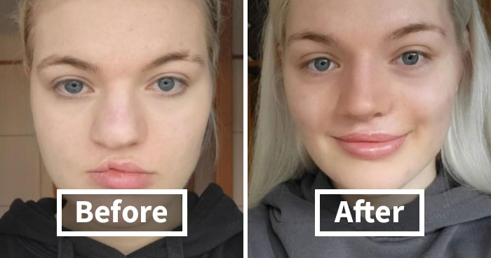 41 Striking Before-And-After Photos Of Plastic Surgery That Seriously Changed People’s Looks