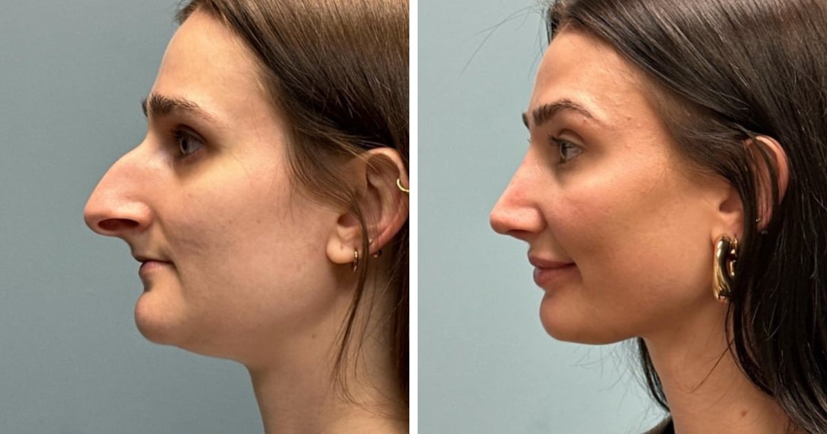 25 Personas que se ven irreconocibles tras su cirugía plástica