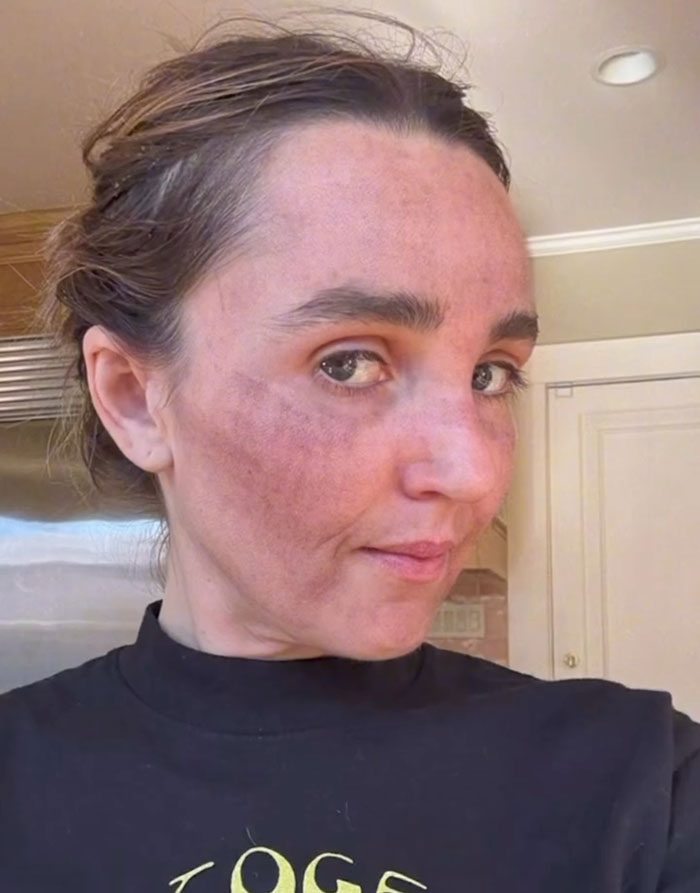 “Really Disturbing”: SNL Star Reveals “Botched” Cosmetic Procedures In Concerning Photos “Really Disturbing”: SNL Star Reveals “Botched” Cosmetic Procedures In Concerning Photos