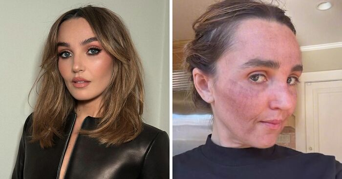 “Really Disturbing”: SNL Star Reveals “Botched” Cosmetic Procedures In Concerning Photos