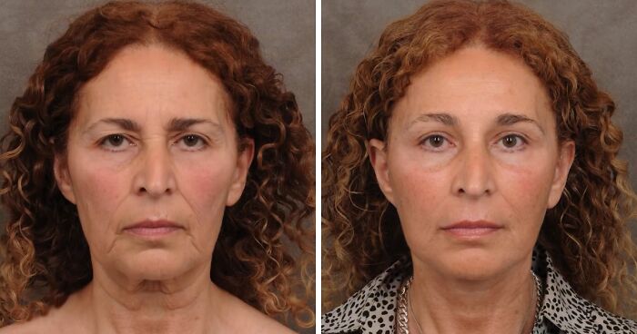 Plastic Surgeon Goes Viral After Dry Response To Facelift Critic Leaves Internet Laughing Hard