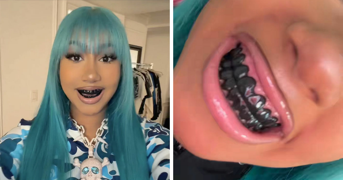 After North West's 'Blackened Teeth' Look Sparks Controversy, Experts Reveal The Hidden Dangers Of Black Grills