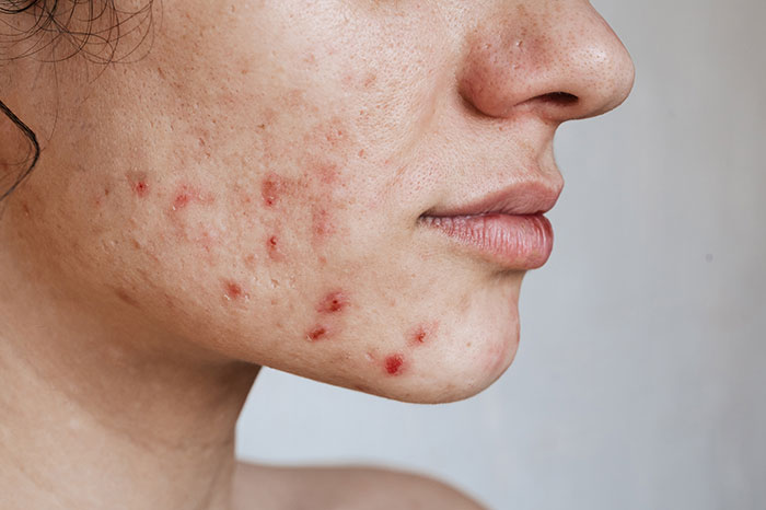 Close-up of a woman’s face showing acne and skin concerns related to women’s bodies and health awareness.