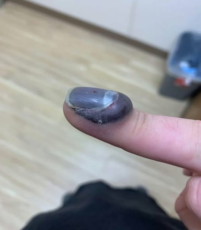 My Finger After Getting It Stuck In A Car Door