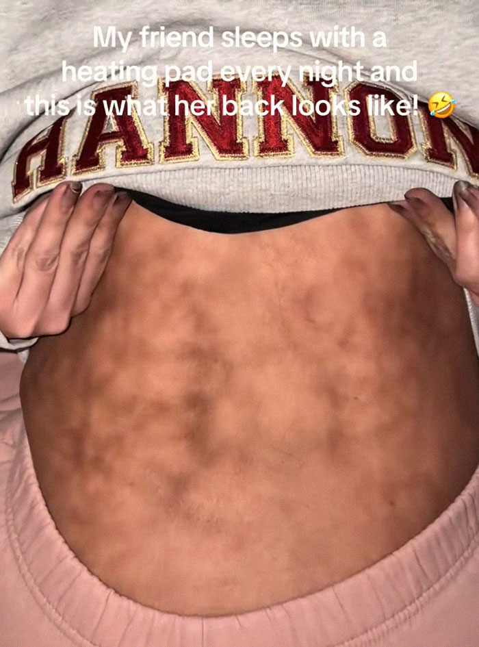 Close-up of a woman&rsquo;s back showing toasted skin syndrome after using a heating pad regularly.
