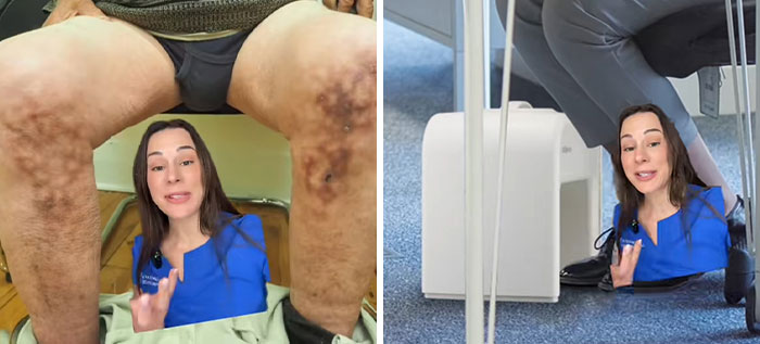 Woman showing toasted skin syndrome on legs caused by using a heating pad, highlighting effects of prolonged heat exposure.