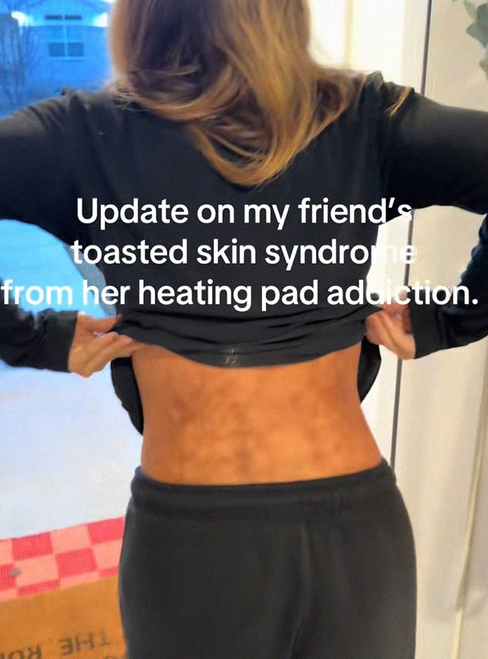 Woman lifting shirt to reveal toasted skin syndrome caused by heating pad use on her lower back.