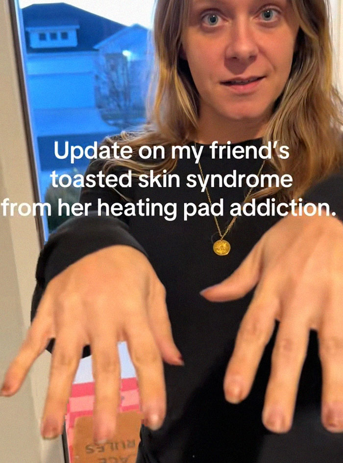 Woman showing hands affected by toasted skin syndrome from heating pad use in a casual indoor setting.
