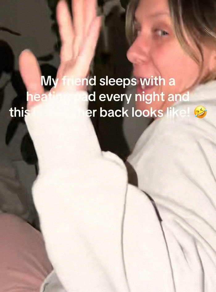 Woman showing skin condition caused by heating pad use, illustrating toasted skin syndrome on her back.