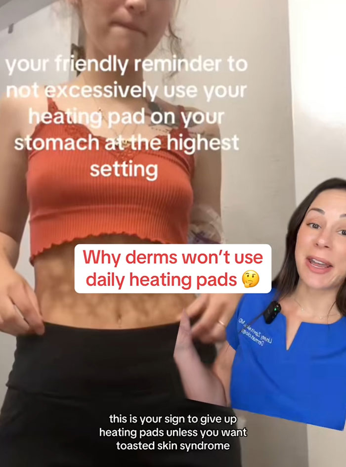 Woman showing stomach with skin affected by toasted skin syndrome after using heating pad excessively