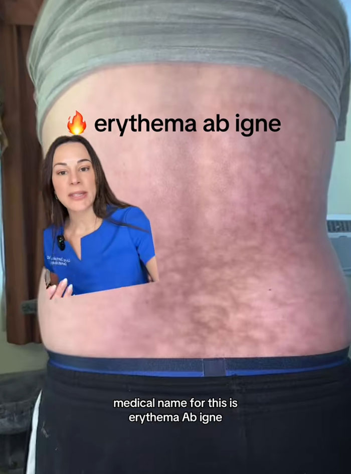 Woman showing back with toasted skin syndrome caused by heating pad use with text erythema ab igne visible.