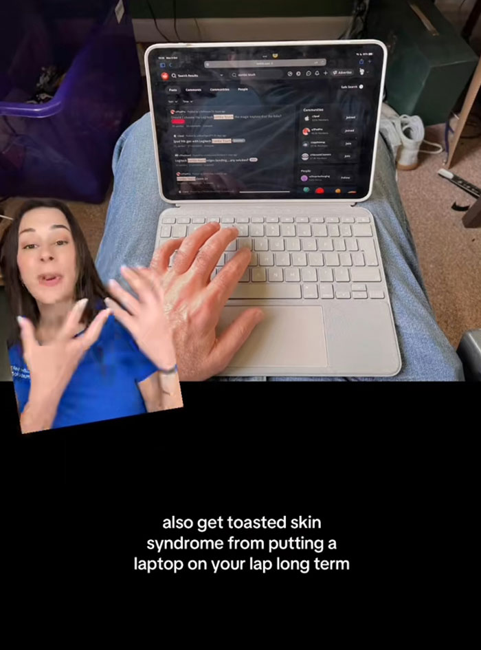 Woman explaining toasted skin syndrome caused by long-term use of a heating pad and laptop heat on the body.