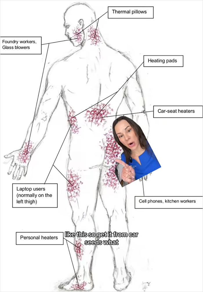 Diagram showing common body areas affected by toasted skin syndrome from heating pads and personal heaters.