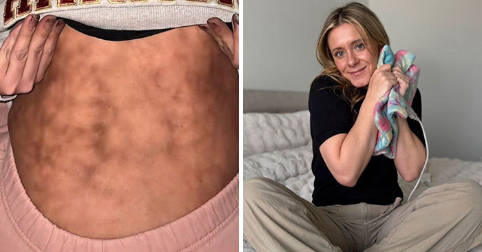 “She’s Literally Cooking Herself”: Woman With ‘Toasted Skin Syndrome’ Goes Viral