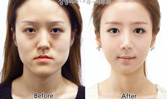 Before and after pics showing dramatic facial transformation with smoother skin and refined features on woman’s face.