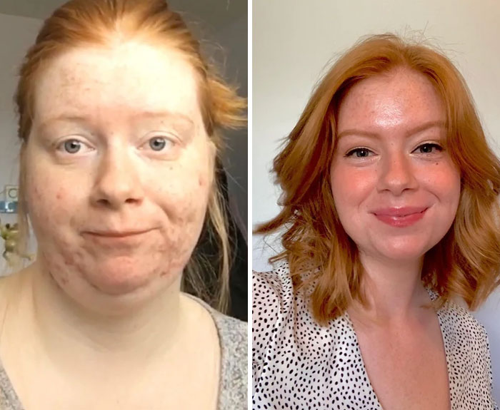 Before and after skincare transformation showing dramatic improvement in skin clarity and complexion in a red-haired woman.