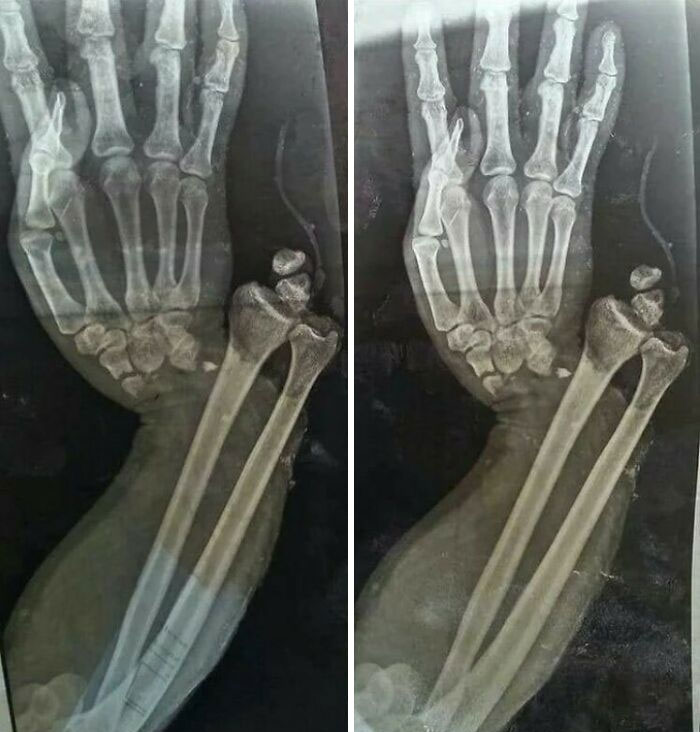 X-ray image showing fractured and misaligned bones in the forearm and hand, a fascinating and unnerving medical pic.