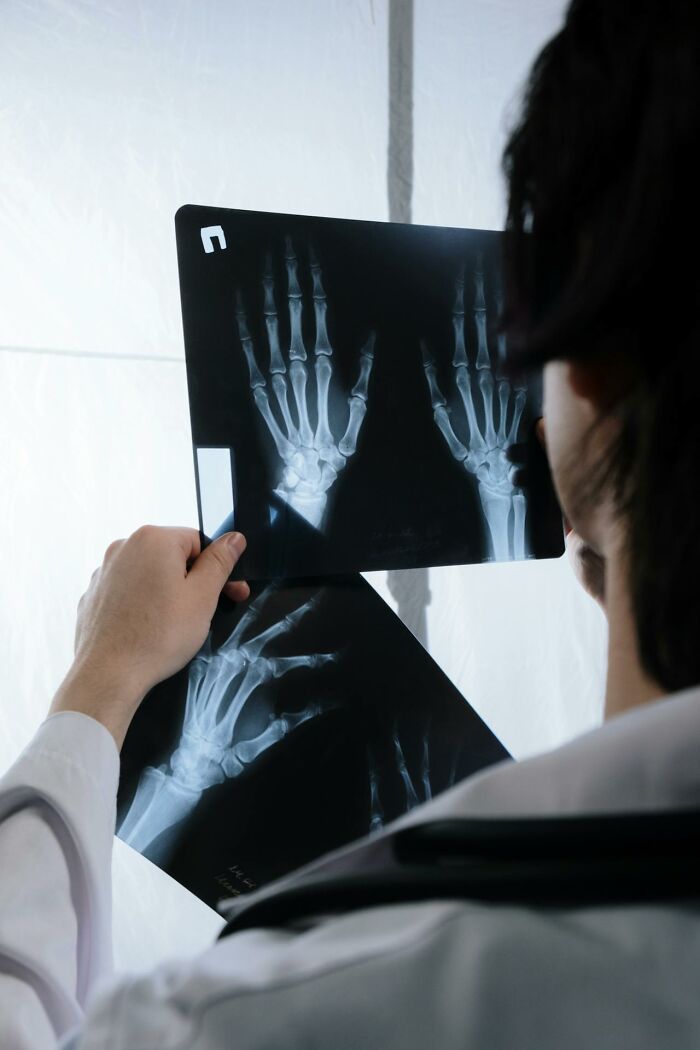 Doctor examining hand X-rays, analyzing unusual medical images related to really bad prognosis cases.
