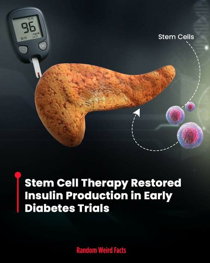 Glucose monitor next to a pancreas and stem cells illustrating stem cell therapy in diabetes research facts.
