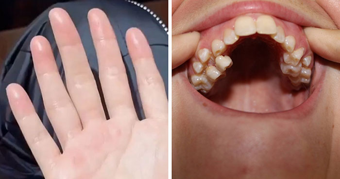 “6 Fingers On Both Hands”: 83 Super Rare Physical Features That You Don’t See Every Day