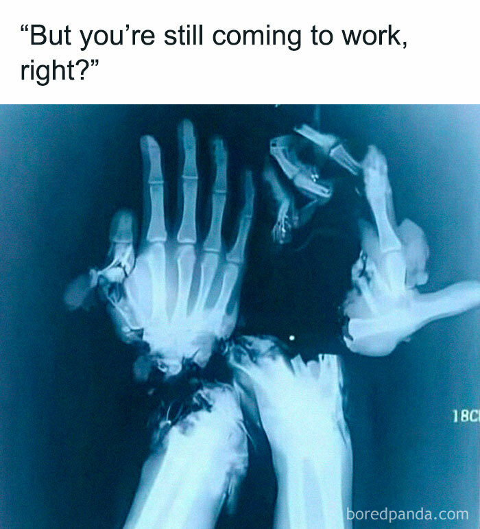 X-ray image of severely damaged hands paired with a caption about still coming to work, illustrating random memes humor.