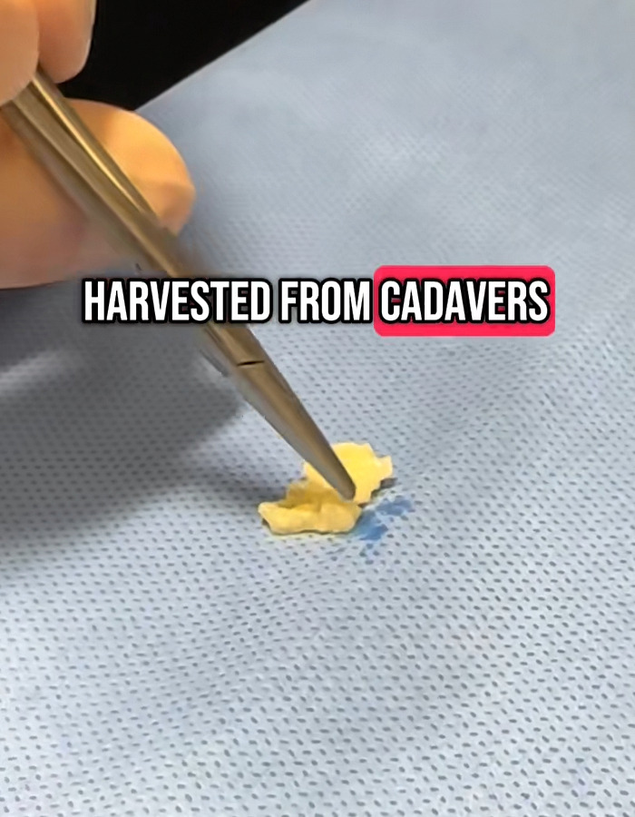 Close-up of surgical tool holding tissue on blue medical cloth with text about donated lifeless bodies for BBLs and breast implants. Close-up of surgical tool holding tissue on blue medical cloth with text about donated lifeless bodies for BBLs and breast implants.