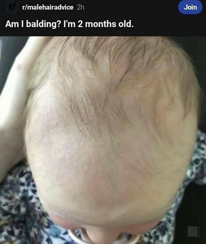 Baby with sparse hair humorously questioned as balding, showcasing one of the hilarious memes with a hint of cynicism.