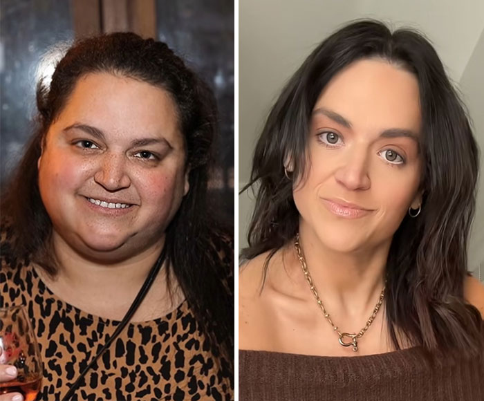 “I’ll Take Ozempic Face”: 77 People Share The Dramatic Facial Changes That Came With Their Ozempic Journey