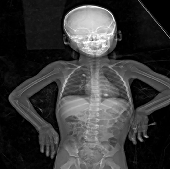 40 Autopsy Doctors Share The Most Bizarre Cases They’ve Ever Seen