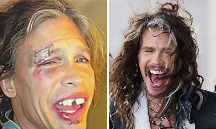 Steven Tyler Before and after celebrity dental implant makeover showing dramatic improvement from gaps to a glamorous smile.