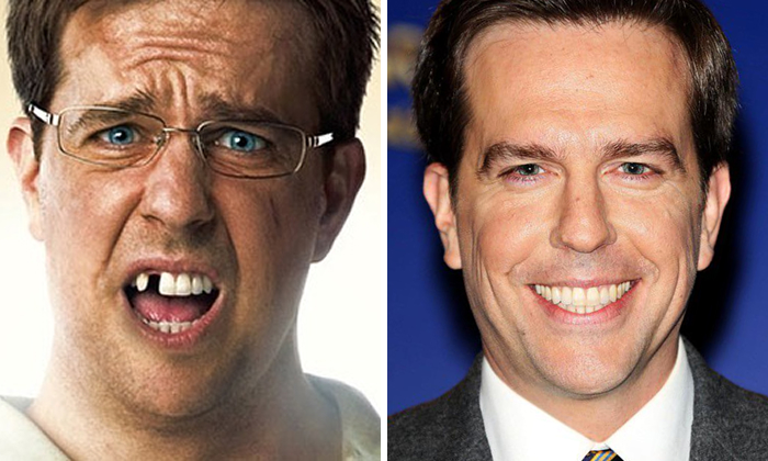 Ed Helms before and after celebrity dental implant makeover showing transformation from gaps to a glamorous smile with perfect teeth.