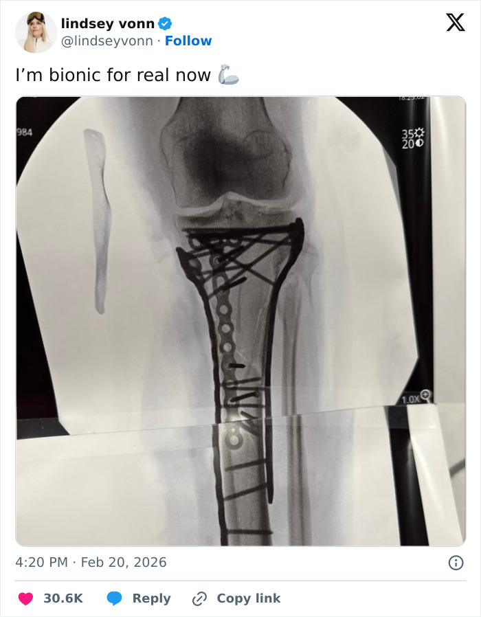 X-ray image showing Lindsey Vonn’s broken leg with metal plates and screws after fifth surgery.