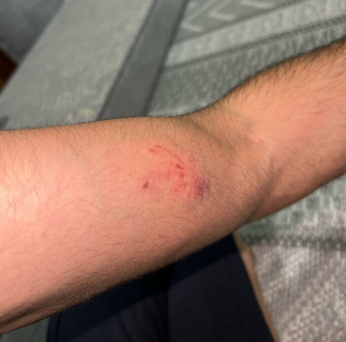 Close-up of a human arm showing a fresh bite mark bruise from a wild dating experience injury.