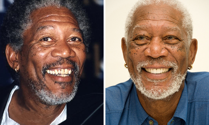 Morgan Freeman Before and after close-up photos of a celebrity smiling, showcasing stunning dental implant makeover results.