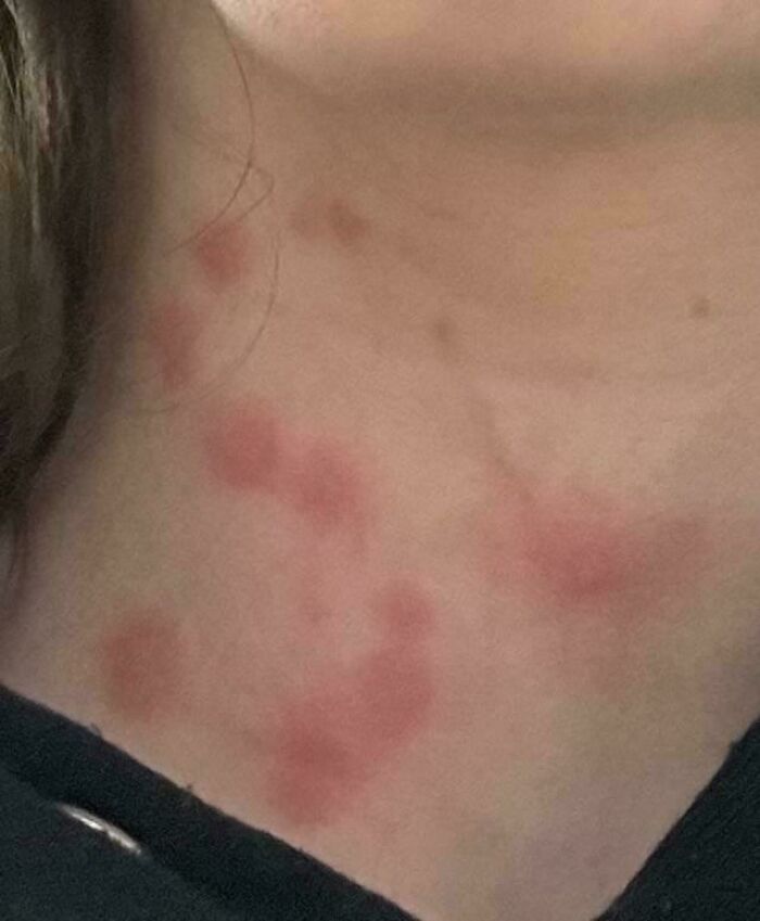 A close-up of a person's neck reveals several red, raised marks, creating a mildly interesting picture.