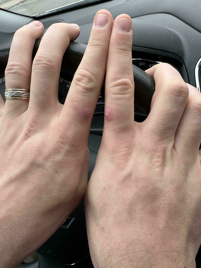 Hands on a steering wheel show two fingers with identical pink marks, making for a mildly interesting picture.