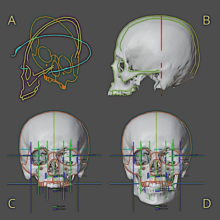Skull scans with overlays and measurements used by a scientist to recreate faces of Mozart, Bach, and Beethoven.