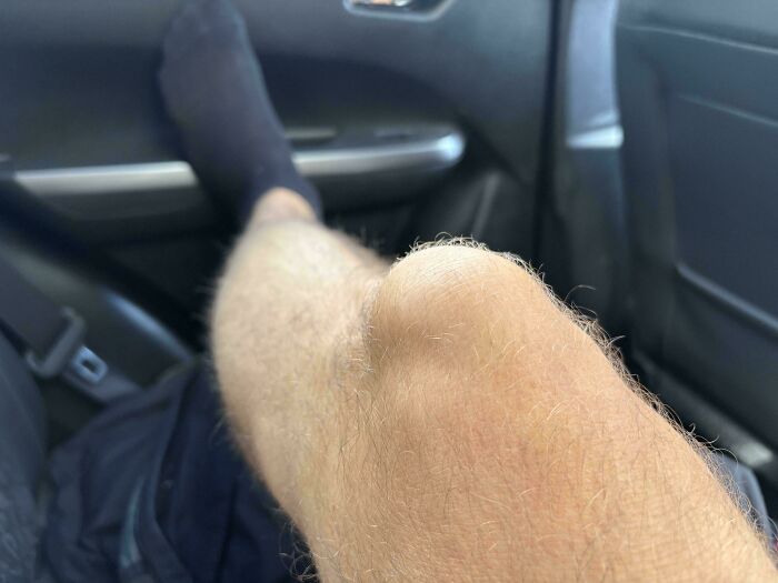 My Knee Spontaneously Doubled In Size