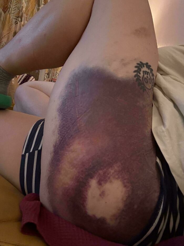 Mega Bruise From E-Scooter Fall