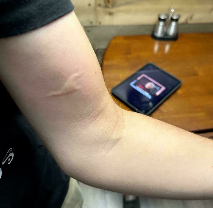 Strangest Mosquito Bite I’ve Every Had