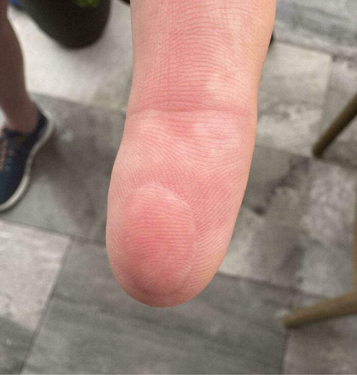 Uncle Severed The Pad Off His Index Finger. Doctor Sutured It On Upside Down