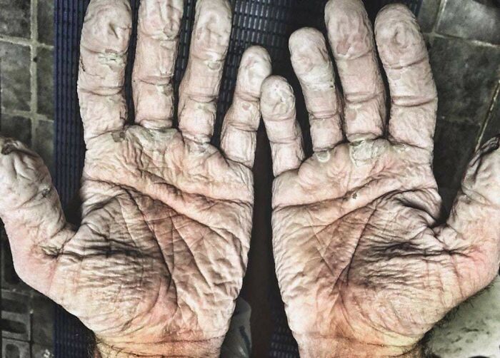 Olympic Rower's Hands After 1,000km Row
