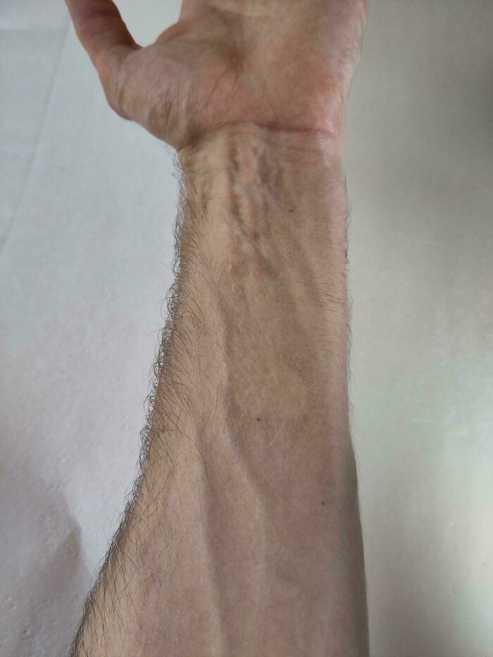 The Imprint Of My Mother's Thumb Burned Into My Forearm