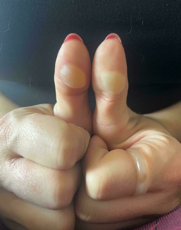 Left: Blister From A Candle Burn. Right: Blister From Frostbite 2 Days Later