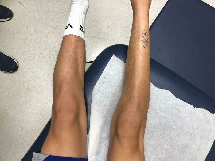 The Difference Between My Atrophied Leg And My Good Leg 2 Weeks After Surgery