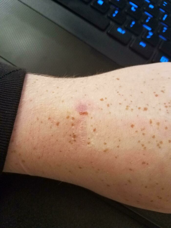 My Surgery Scar Split A Freckle In Half And It Grew Back Over The Scar